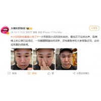 小沈阳一觉睡醒眼睛肿成蜜蜂小狗，公演前夕意外！